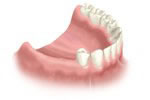 Pacient cu edentatie laterala - dinti lipsa doar pe una din parti 